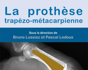 La prothèse trapézo-métacarpienne